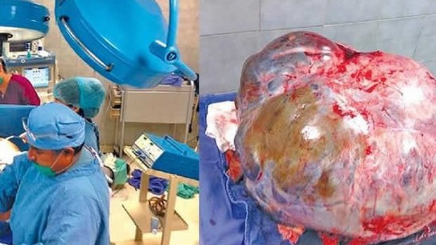 Extirpan a mujer un tumor de más de 60 kilos, en Cabo San Lucas