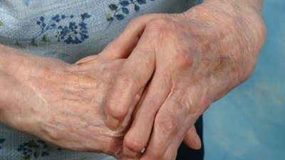 Artritis afecta a chihuahuenses