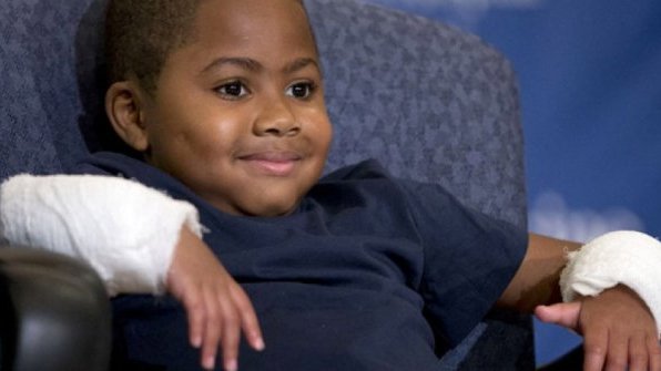 El primer niño del mundo que recibe un doble trasplante de manos