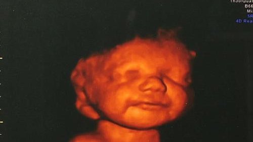  Tras sonreír en ecografía 3D, bebé se salva de ser abortado