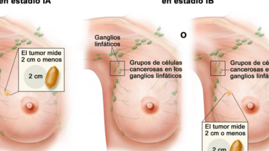 Chihuahua, con la tasa de mortalidad más alta de cáncer de mama
