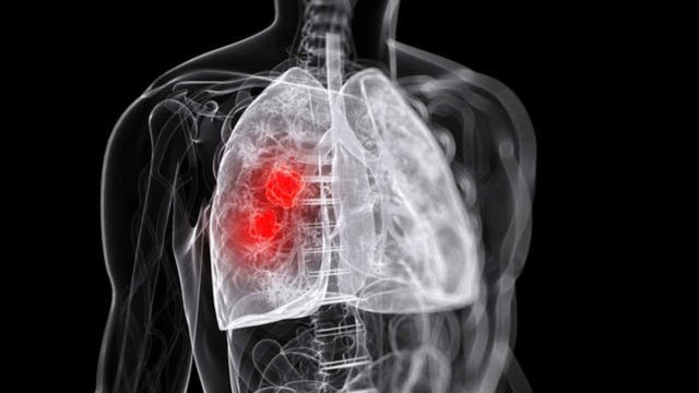 Mueren 6 mil mexicanos por cáncer de pulmón cada año