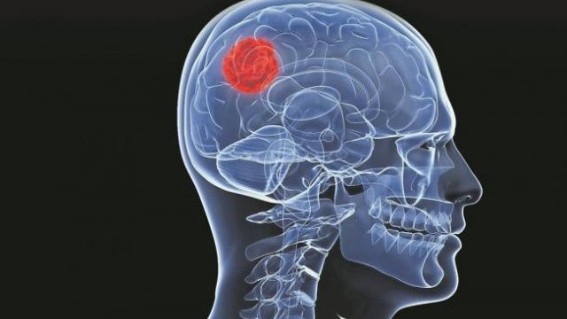 Fármaco disminuye crecimiento de tumores cerebrales