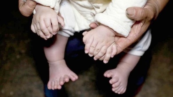 Un bebé nace con 31 dedos en China