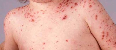 Alertan por brote infeccioso de varicela