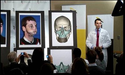Cirujanos de EEUU realizan un revolucionario trasplante de cara 